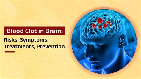 clots citi|Blood Clot in Brain: Survival, Treatment, Post.